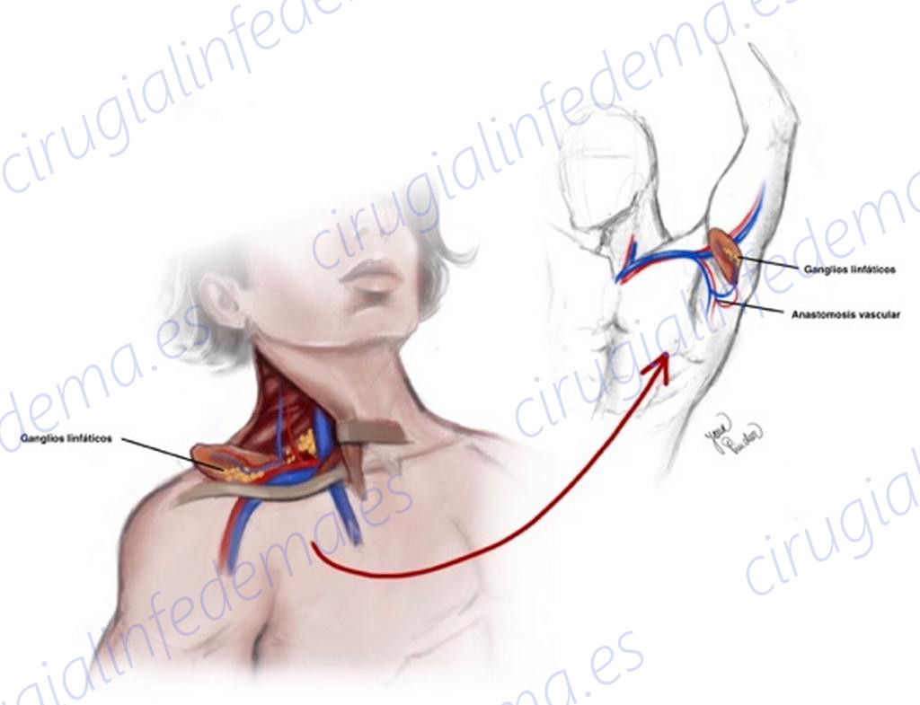Diagrama de técnica quirúrgica de transplante de ganglios