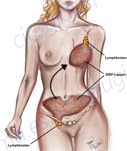Diagrama de ejemplo de linfedema asociado al cáncer de mama